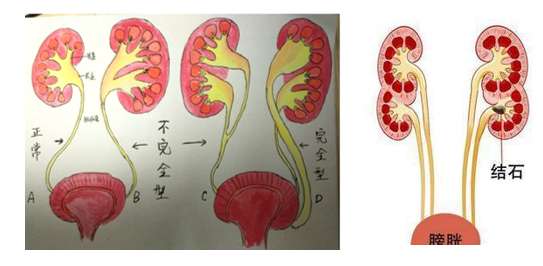 肾发育畸形有什么影响_肾发育不良伴哪些畸形_肾伴发育不良畸形能治好吗