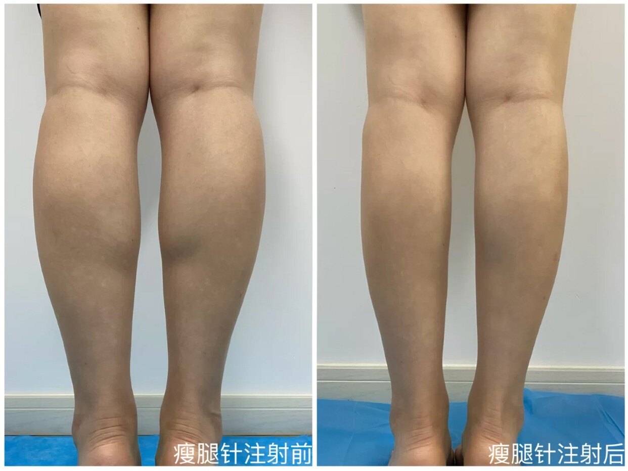 botox瘦小腿_小粗腿怎么瘦视频_botox瘦小腿价格